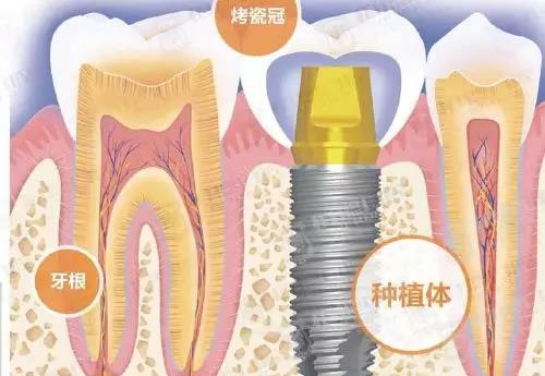 种植牙到底是怎么种的？