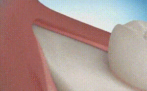 智齿到底该不该拔？如何缓解牙部疼痛？