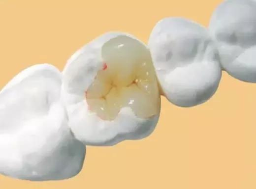 五种常见的补牙材料对比，看完你还犹豫用什么材料吗？