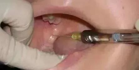 小孩子拔牙可以用麻药吗？