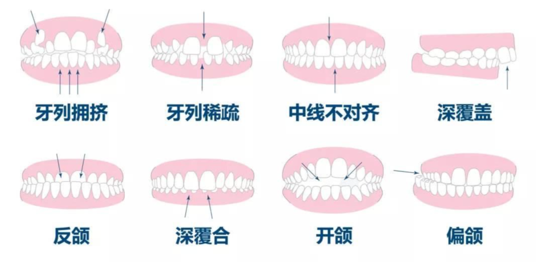 到底什么样的牙齿需要做矫正？