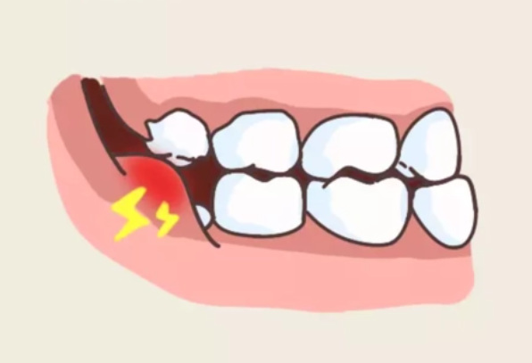 智齿有问题，越早拔越好？