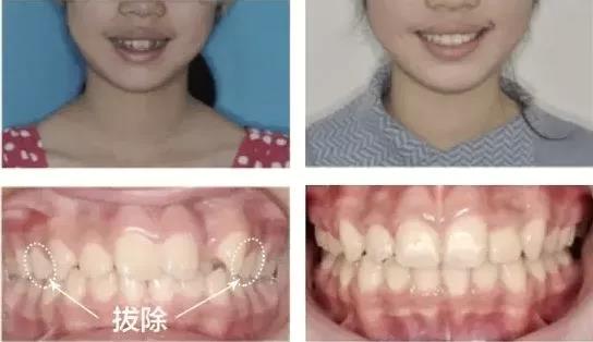 为什么有的人矫正时需要拔牙？不拔会怎样？