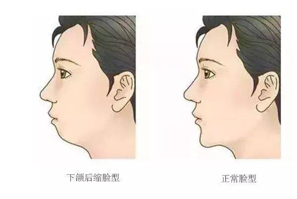 你的牙齿是否属于这几种情况？
