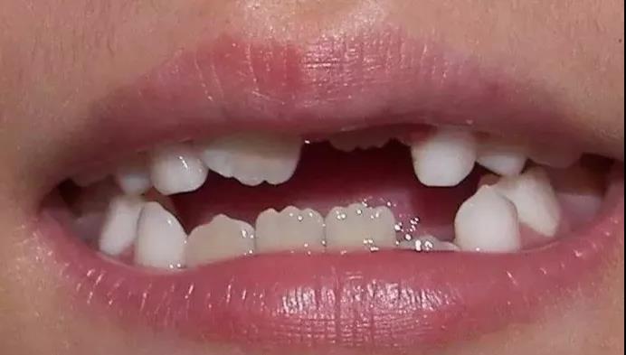 孩子新换的门牙出现锯齿状？长大了会消失吗？
