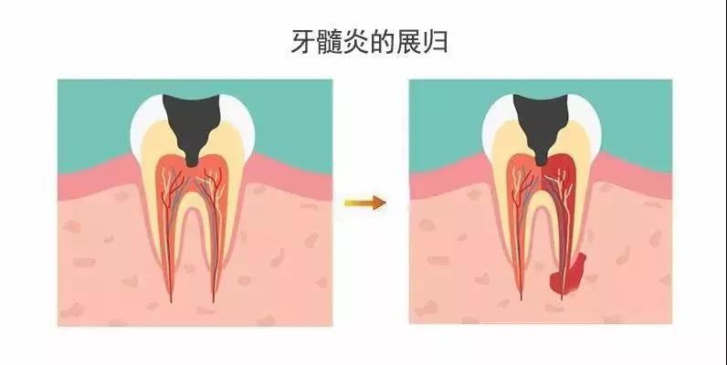 什么是牙髓炎？牙髓炎可以自愈吗？