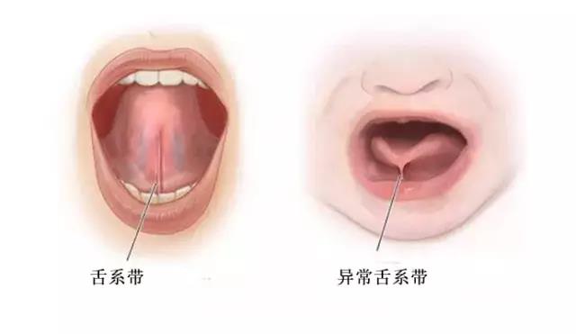 这20种儿童牙颌畸形12岁前必须处理!