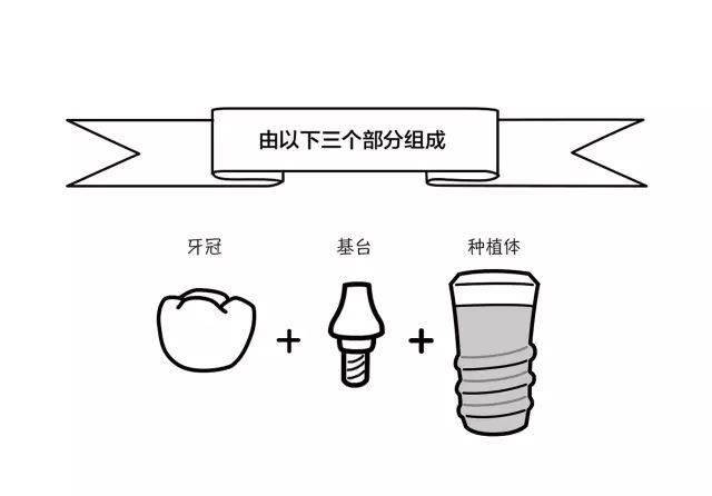 一文教会您怎么挑选种植体！
