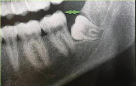 关于拔牙的认识误区