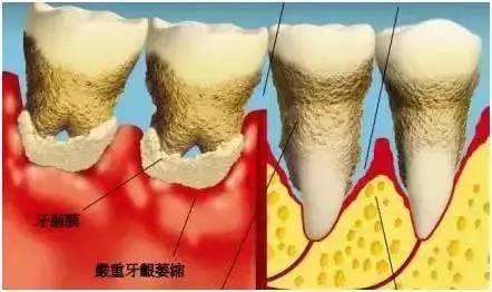 牙齿为什么容易松动？