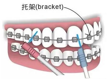 牙齿矫正这14个 ‘副作用’ 你信了几个？