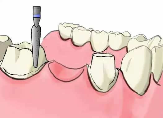 全口假牙的常见问题