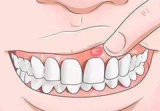 缺少哪种维生素容易患口腔溃疡？