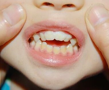 孩子牙齿畸形可能会影响脸型！