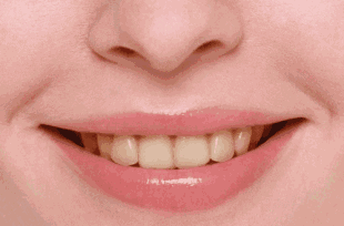 牙齿美白一次多少钱？