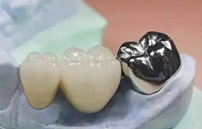烤瓷牙的优缺点是什么，会出现哪些危害？
