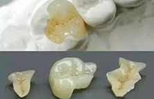 补牙后牙齿敏感疼痛的原因是什么？