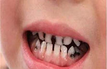 是什么原因引起的龋齿，怎么预防？