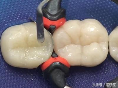 补牙材料会影响牙神经吗？