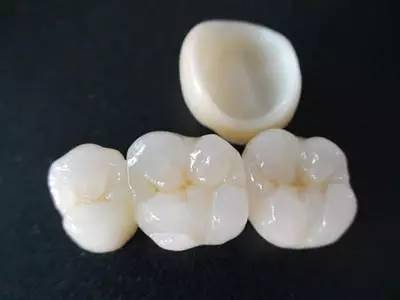 怎么正确认识全瓷牙？