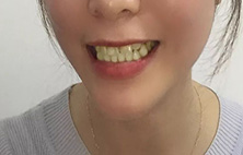 牙齿黄怎么办，牙齿黄的原因是什么？