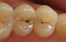 牙齿上有黑点到底有多可怕？