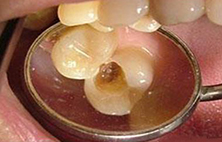 蛀牙如何让它停止腐蚀？