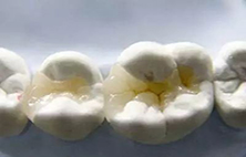 缺牙后，选择什么方式补牙比较好？