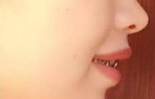 龅牙矫正，你注意到这点了吗？
