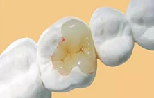 现在补牙价格昂贵，补牙材料真的物有所值吗？