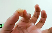 智齿该不该拔？智齿长得不好，不拔掉有3个坏处！
