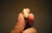 拔牙有什么危险吗？拔牙前后注意这几点，就不用担惊受怕了！