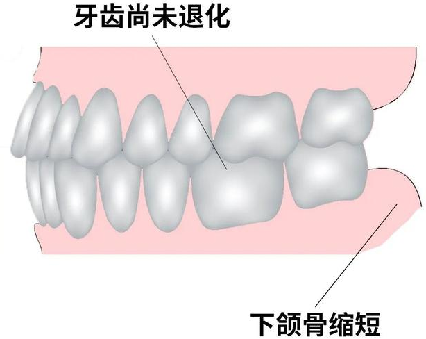 牙齿矫正