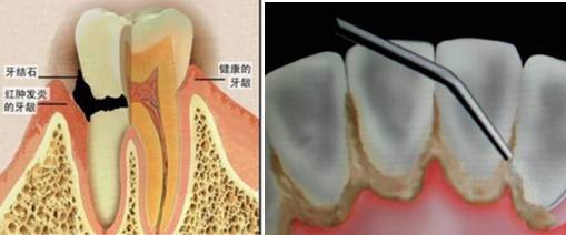 牙结石症状.jpg
