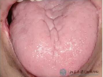 舌痛症.jpg