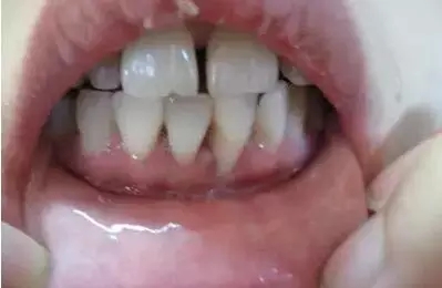 牙龈萎缩.jpg