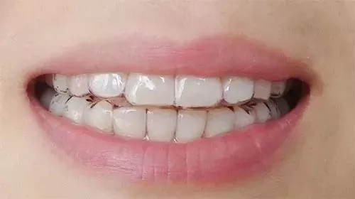 牙齿矫正.png