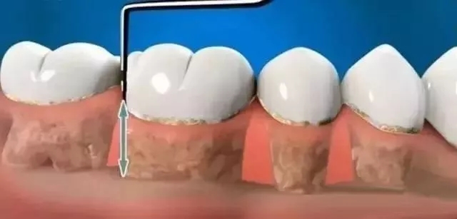 洗牙.jpg