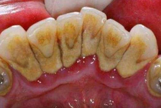 牙龈出血的照片图片